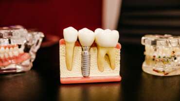 Implanty stomatologiczne – kompletny i piękny uśmiech w zasięgu ręki